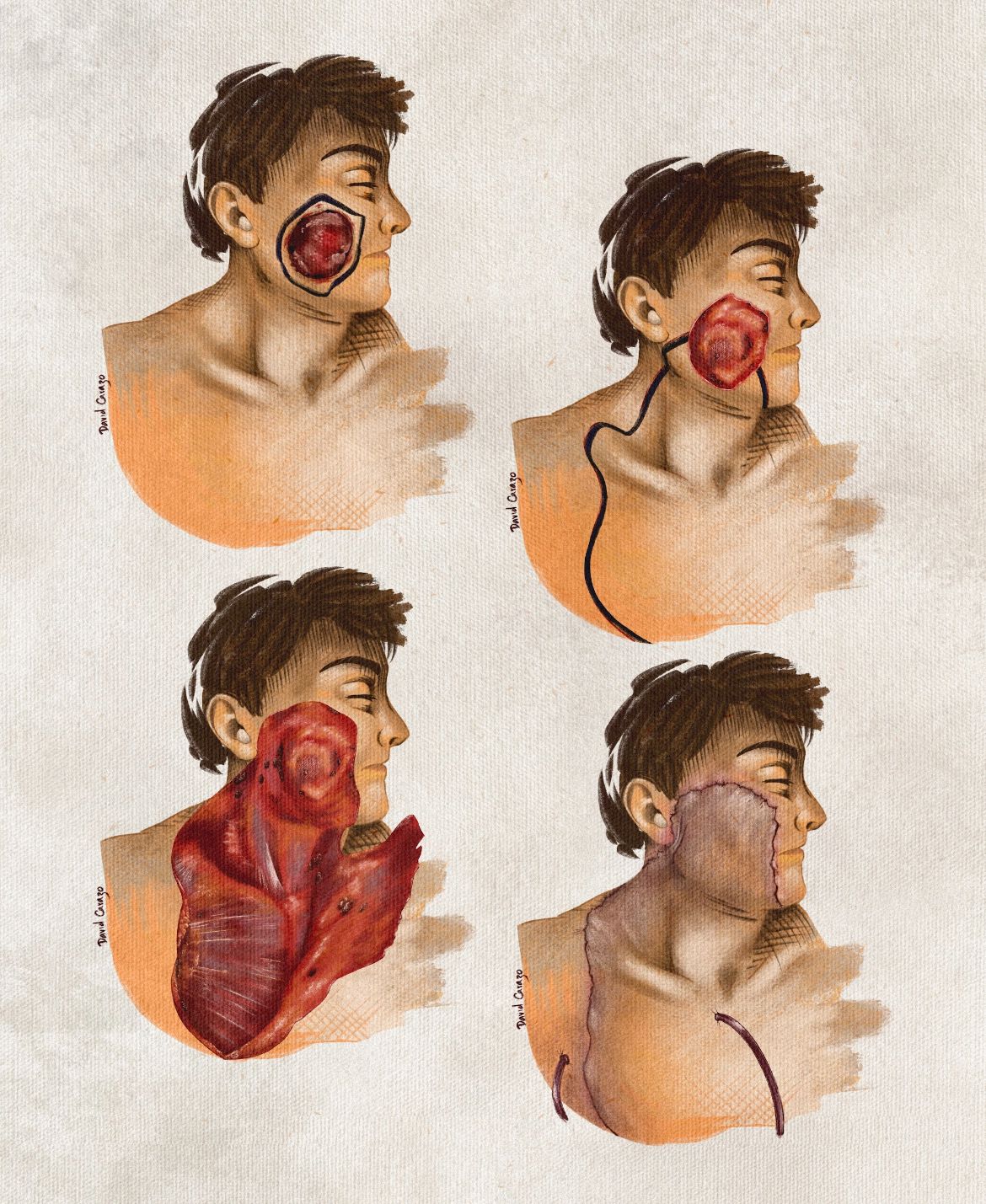 Ilustración — Colgajo cervicotorácico